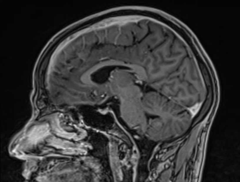 Cerebral venous thrombosis (Radiopaedia 71207-81504 Sagittal T1 C+ 33).jpg