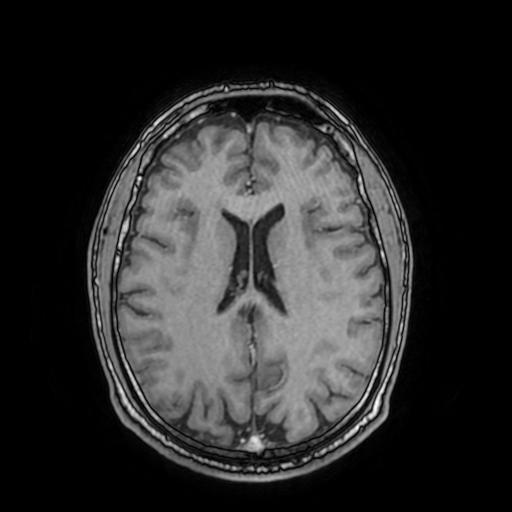 Cerebral venous thrombosis with secondary intracranial hypertension (Radiopaedia 89842-106957 Axial T1 C+ 111).jpg