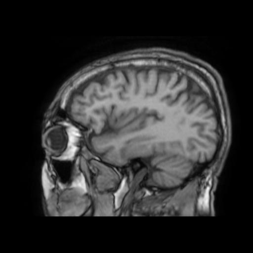 File:Cerebral venous thrombosis with secondary intracranial hypertension (Radiopaedia 89842-106957 Sagittal T1 23).jpg