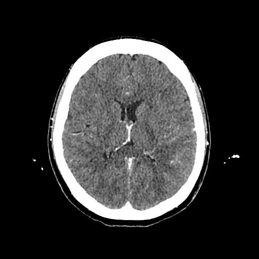 Cerebral venous thrombosis with venous hemorrhagic infarct (Radiopaedia 90354-107660 Axial with contrast 96).jpg