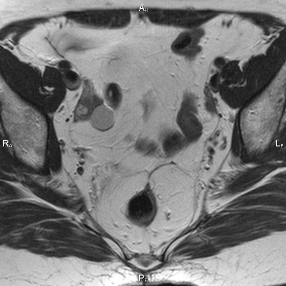 File:Cervical adenocarcinoma (Radiopaedia 65011-73985 Axial T2 24).jpg
