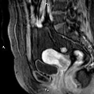 File:Cervical adenocarcinoma (Radiopaedia 65011-73985 E 15).jpg