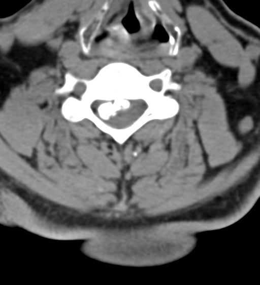 File:Cervical canal stenosis - OPLL and osteophytes (Radiopaedia 47329-51910 Axial non-contrast 36).png