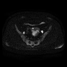 File:Cervical carcinoma (Radiopaedia 67644-77047 Axial DWI 9).jpg