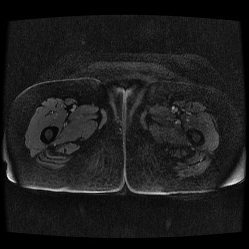 Cervical carcinoma (Radiopaedia 70924-81132 Axial T1 C+ fat sat 4).jpg