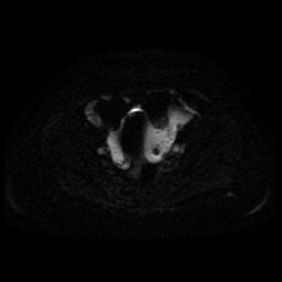 Cervical carcinoma (Radiopaedia 85405-101028 Axial DWI 34).jpg