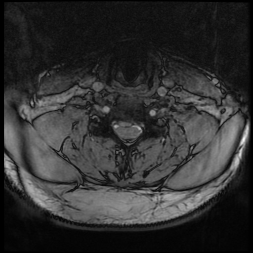 Cervical disc extrusion (Radiopaedia 59074-66364 G 62).jpg