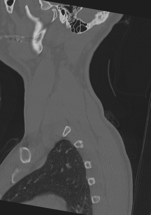 Cervical intercalary bone (Radiopaedia 35211-36748 Sagittal bone window 9).png