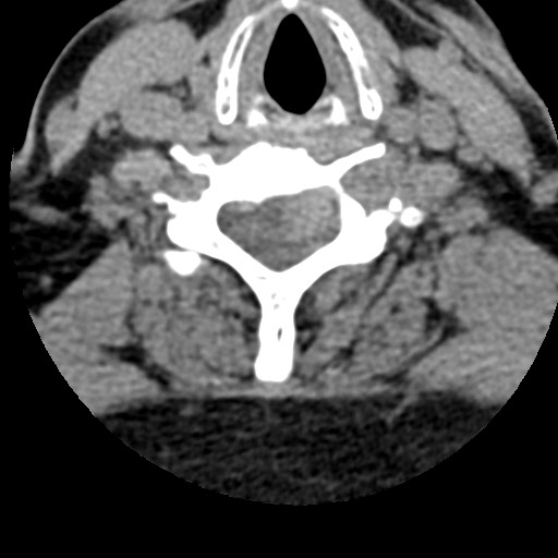 File:Cervical spinal neurofibroma in a patient with NF1 (Radiopaedia 58344-65464 Axial non-contrast 52).jpg
