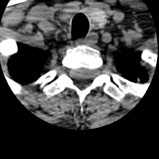 Cervical spinal neurofibroma in a patient with NF1 (Radiopaedia 58344-65464 Axial non-contrast 71).jpg