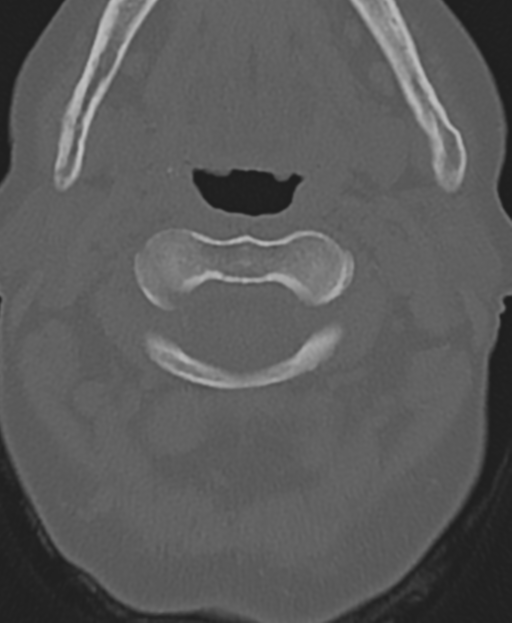 Cervical spine ACDF loosening (Radiopaedia 48998-54071 Axial bone window 17).png