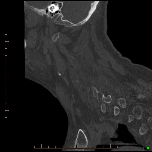 Cervical spine fracture - ankylosing spondylitis (Radiopaedia 76835-88706 Sagittal bone window 26).jpg