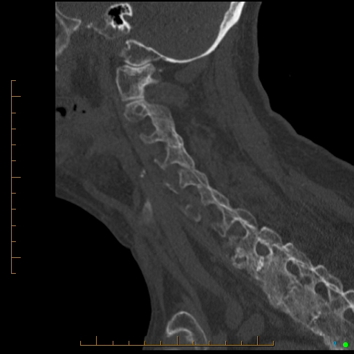 Cervical spine fracture - ankylosing spondylitis (Radiopaedia 76835-88706 Sagittal bone window 38).jpg