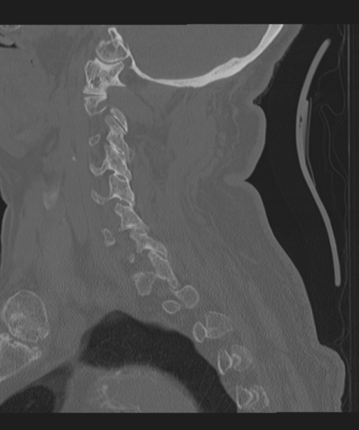 Cervical spine fracture in the setting of ankylosis (Radiopaedia 37038-38715 Sagittal bone window 26).png