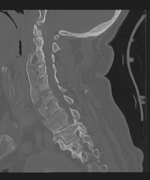 Cervical spine fracture in the setting of ankylosis (Radiopaedia 37038-38715 Sagittal bone window 34).png