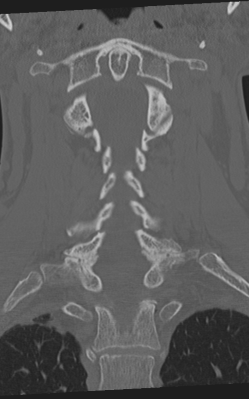 Cervical spine fractures with vertebral artery dissection (Radiopaedia 53296-59268 Coronal bone window 37).png