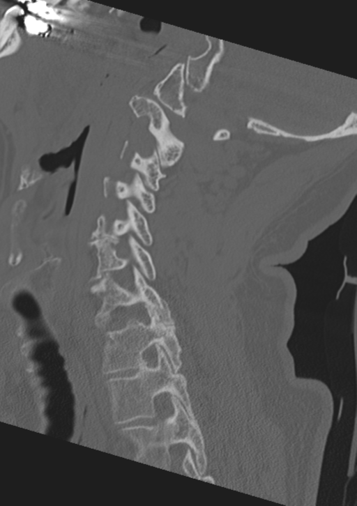 Cervical spine fractures with vertebral artery dissection (Radiopaedia 53296-59268 Sagittal bone window 25).png