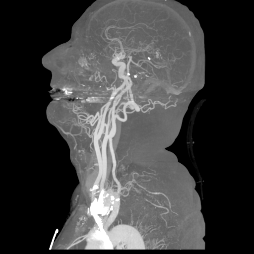 File:Cervical spine fractures with vertebral artery dissection (Radiopaedia 53296-59269 3D MIP 19).png