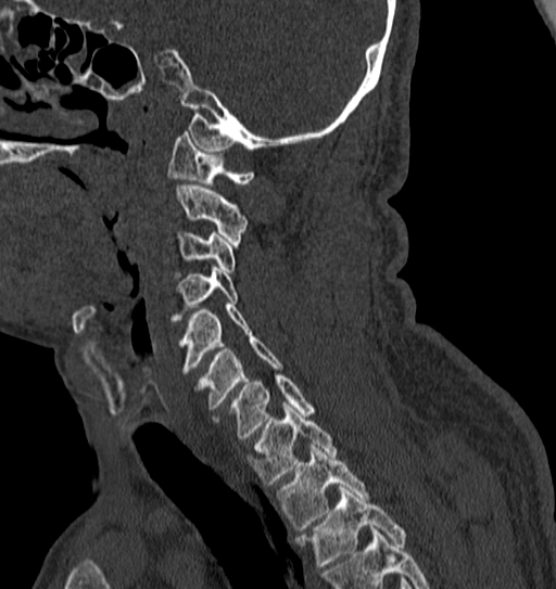 Cervical spine trauma with tear drop fracture and perched facet joint (Radiopaedia 53989-60127 Sagittal bone window 51).jpg
