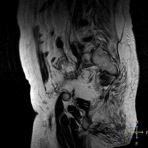 File:Cervical stump squamous cell carcinoma (Radiopaedia 48049-52858 Sagittal T2 15).jpg
