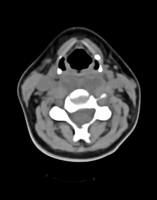 Cervical tuberculous spondylitis (Radiopaedia 39149-41365 Axial non-contrast 24).png