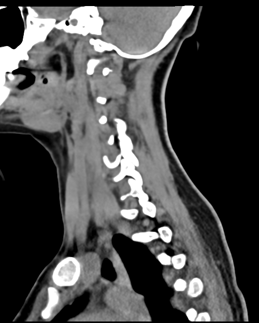 Cervical tuberculous spondylitis (Radiopaedia 39149-41365 D 21).png