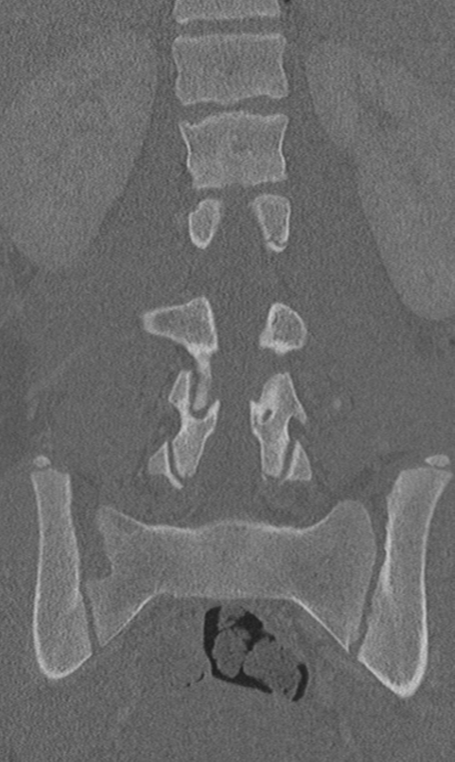 Chance fracture (Radiopaedia 40360-42912 Coronal bone window 39).png