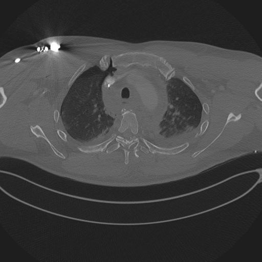 Chest multitrauma - aortic injury (Radiopaedia 34708-36147 Axial bone window 76).png