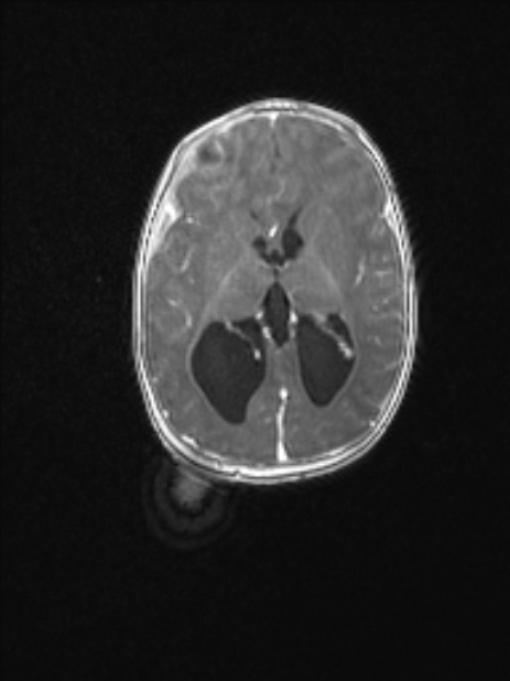Chiari III malformation with occipital encephalocele (Radiopaedia 79446-92559 Axial T1 C+ mpr 52).jpg