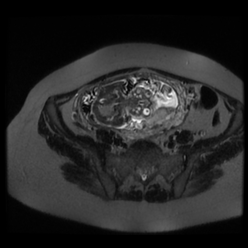 Chiari II malformation - fetal MRI (Radiopaedia 68099-77581 Axial T2-SSFSE 36).jpg