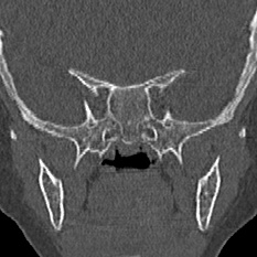 Choanal atresia (Radiopaedia 88525-105975 Coronal bone window 87).jpg