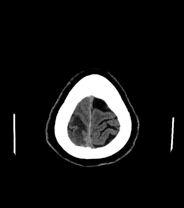 Cholangiocarcinoma with cerebral metastases (Radiopaedia 83519-98628 Axial non-contrast 59).jpg