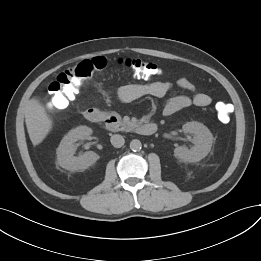Cholecystitis with focal perforation and hepatic abscess (Radiopaedia 37189-38945 Axial non-contrast 37).png
