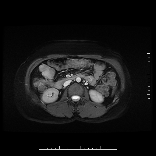 File:Choledochal cyst with chronic calcific pancreatitis (Radiopaedia 18245-18062 Axial T2 13).png