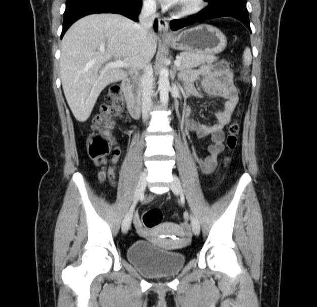 Choledocholithiasis on CT and MRI (Radiopaedia 24825-25087 C 26).jpg