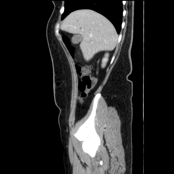 Choledocholithiasis on CT and MRI (Radiopaedia 24825-25087 D 15).jpg