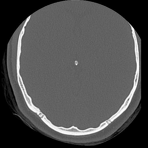 Cholesteatoma (Radiopaedia 84960-100474 Axial bone window 2).jpg
