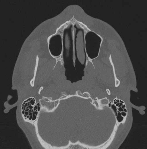 Chondrosarcoma (clivus) (Radiopaedia 46895-51425 Axial bone window 70).png