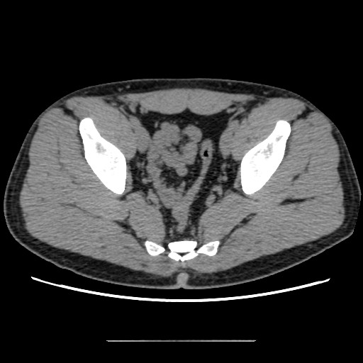 Chondrosarcoma of iliac wing (Radiopaedia 63861-72599 Axial non-contrast 83).jpg
