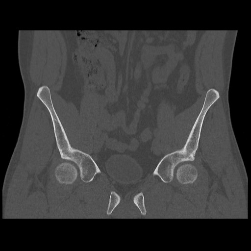 Chondrosarcoma of iliac wing (Radiopaedia 63861-72599 Coronal bone window 45).jpg