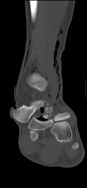Chopart fracture (Radiopaedia 35347-36851 Coronal bone window 41).jpg