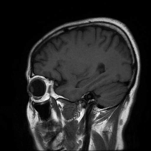 File:Chordoid glioma of third ventricle (Radiopaedia 91612-109340 Sagittal T1 6).jpg