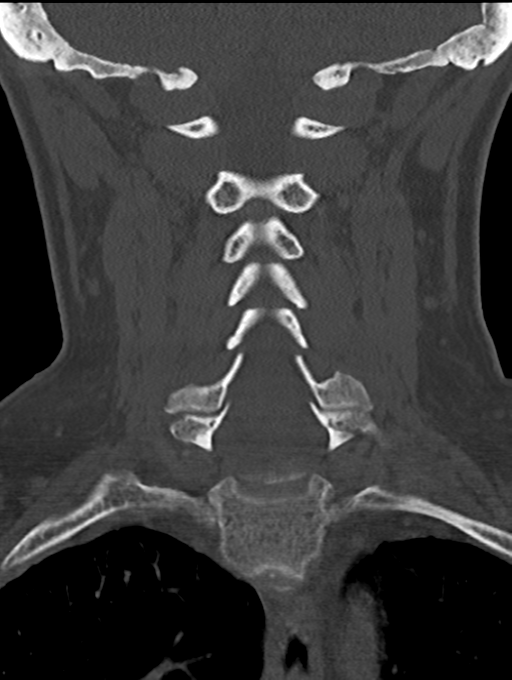 Chordoma (C4 vertebra) (Radiopaedia 47561-52188 Coronal bone window 31).png