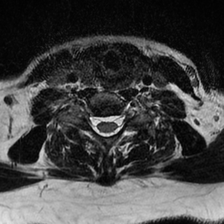 Chordoma - cervical spine (Radiopaedia 70084-80111 Axial T2 67).png