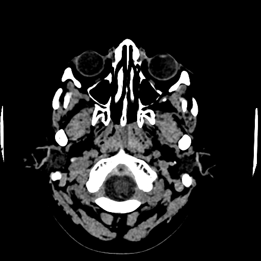 Choroid plexus xanthogranulomas (Radiopaedia 51621-57408 Axial non-contrast 4).jpg