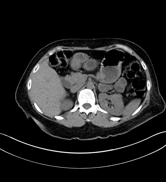 Chromophobe renal cell carcinoma (Radiopaedia 84290-99582 Axial non-contrast 47).jpg