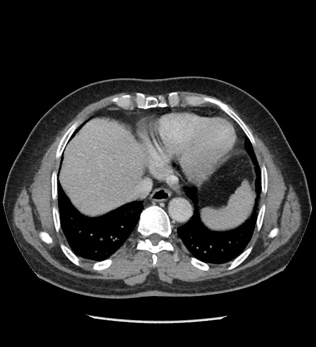 Chromophobe renal cell carcinoma (Radiopaedia 86879-103083 C 9).jpg