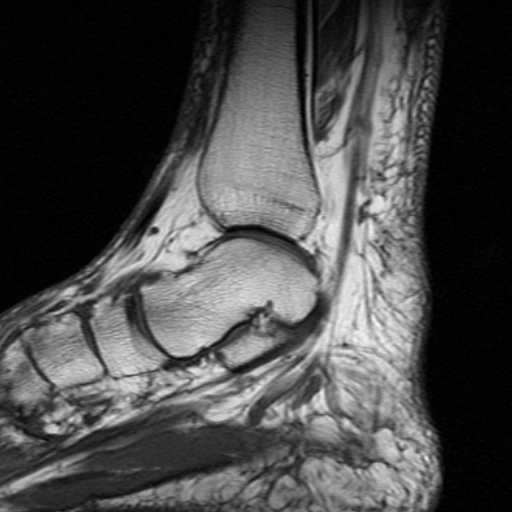 File:Chronic Achilles tendon rupture (Radiopaedia 15262-15100 Sagittal T1 10).jpg