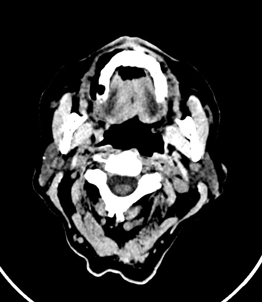 Chronic bilateral subdural hygroma (Radiopaedia 85801-101623 Axial non-contrast 65).jpg