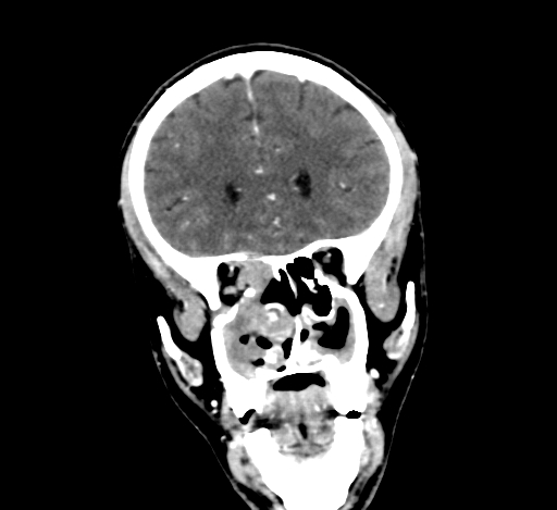 Chronic invasive fungal sinusitis with intraorbital and intracranial extension (Radiopaedia 56387-63046 C 126).jpg